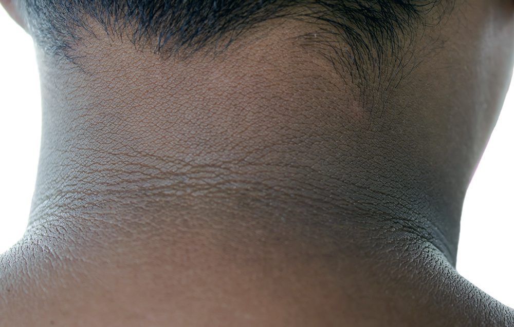 Oscurecimiento de la parte posterior del cuello signo de prediabetes: experto
