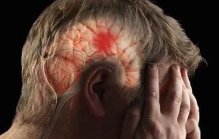 Señales de que estás a punto de sufrir un derrame cerebral