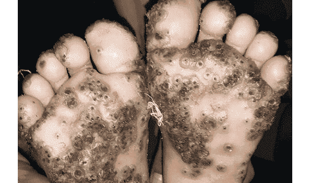 Niña de 10 años se infecta de pulgas; se le incrustan en los pies