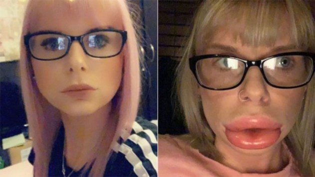 Mujer quedó desfigurada tras inyectarse botox en los labios