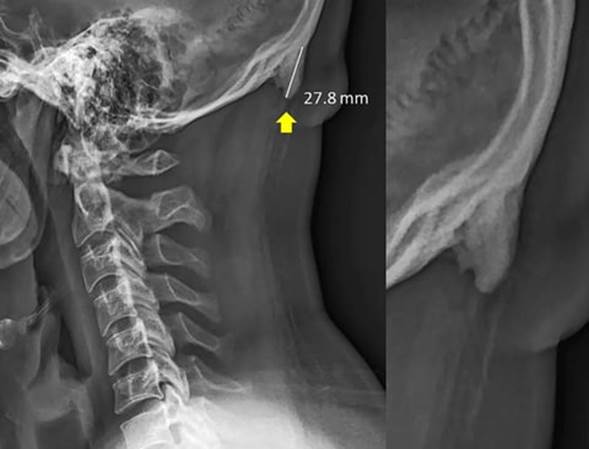 Uso del celular puede crearle un cuerno en el cráneo a jóvenes