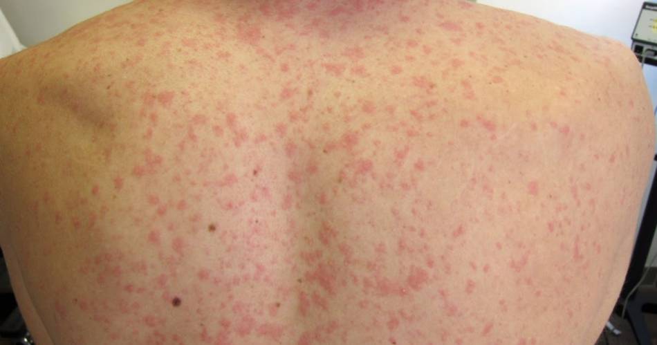 Aumenta a 515 casos de sarampión en el país