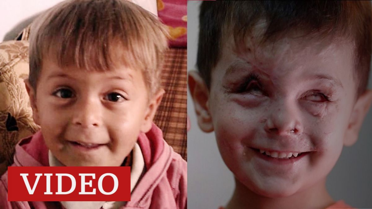 La devastadora historia de Jouma, el niño de 4 años cuyo rostro fue desfigurado