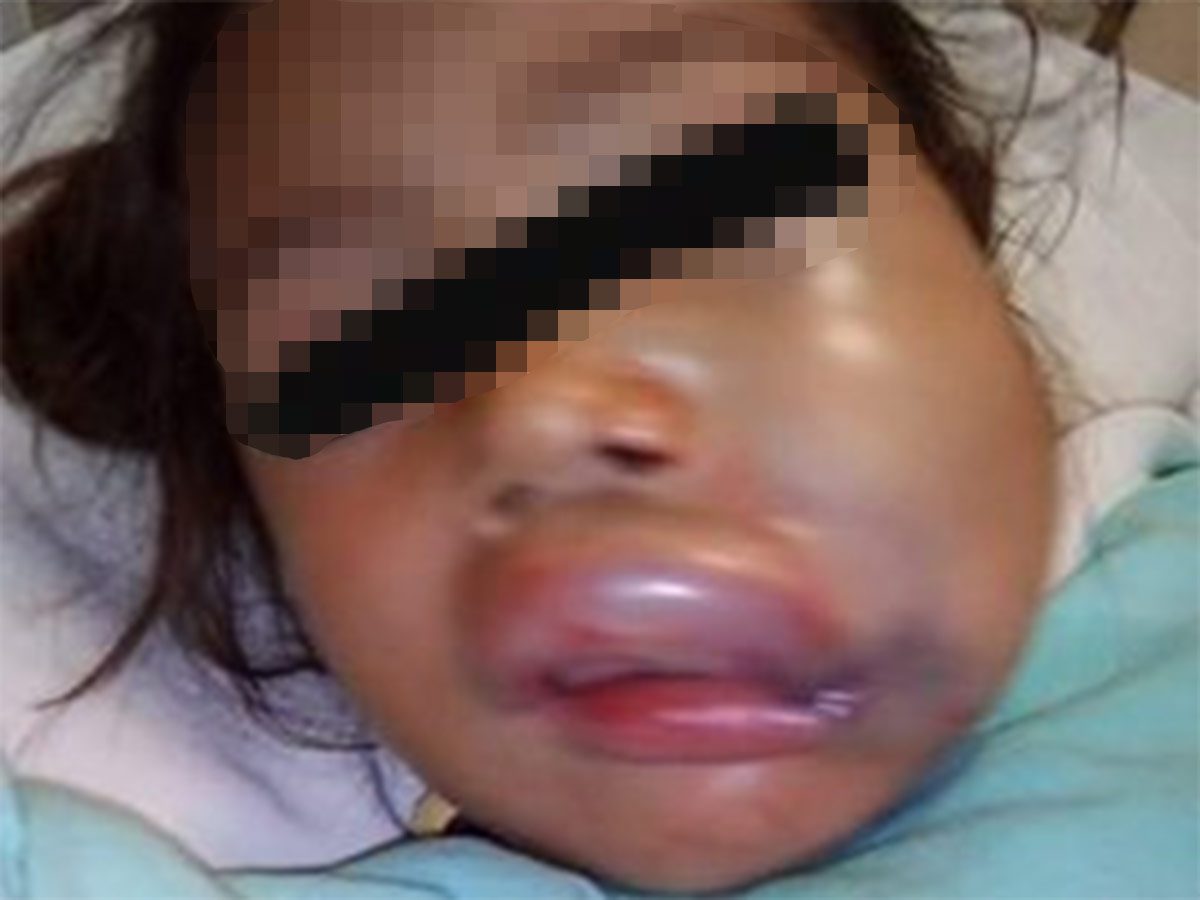 Kínder entrega a niña con labios hinchados y moretones; ‘está bien’ dicen maestras