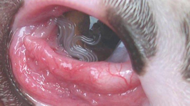 Gusanos parasitarios invaden el ojo de una mujer