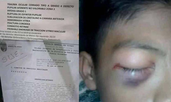Estudiante de secundaria pierde ojo después de golpiza de compañeros