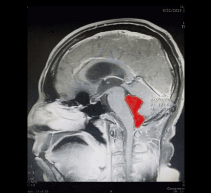 Extirpan lombriz que vivió 10 años en el cerebro de un hombre
