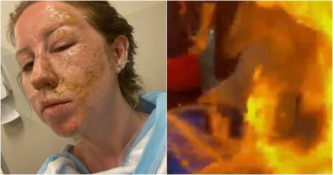 Meseros encienden bebida y queman el rostro de una mujer en un bar de Cancún