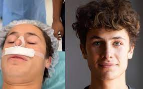 Juanpa Zurita sometido nuevamente a una operación de nariz