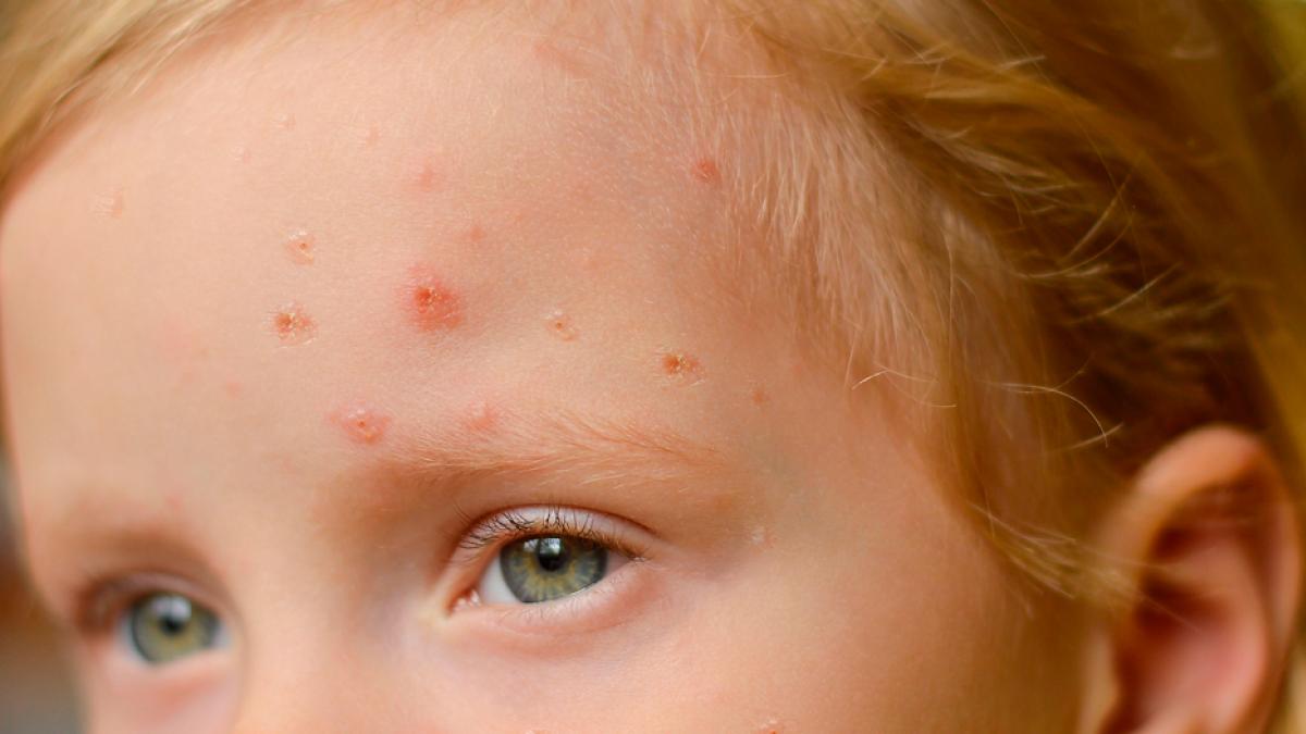 Se registra los primeros casos de viruela del mono en menores de edad