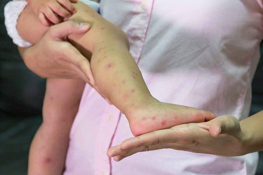 Confirman cuatro casos del virus de coxsackie en escuela de Morelos