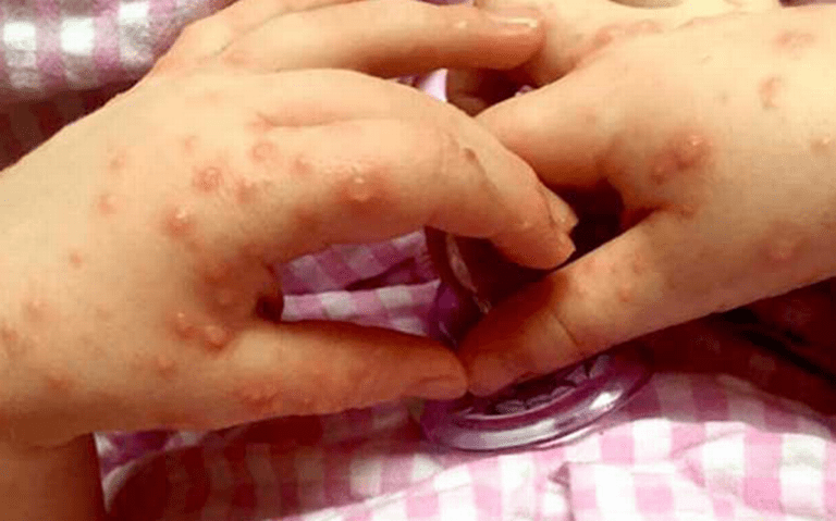 Confirman cuatro casos del virus de coxsackie en escuela de Morelos