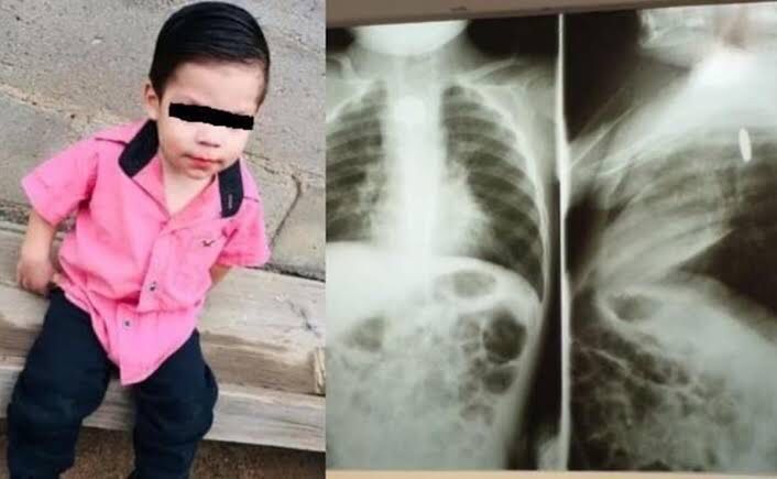 Bebé de 2 años en terapia intensiva tras tragarse una pila