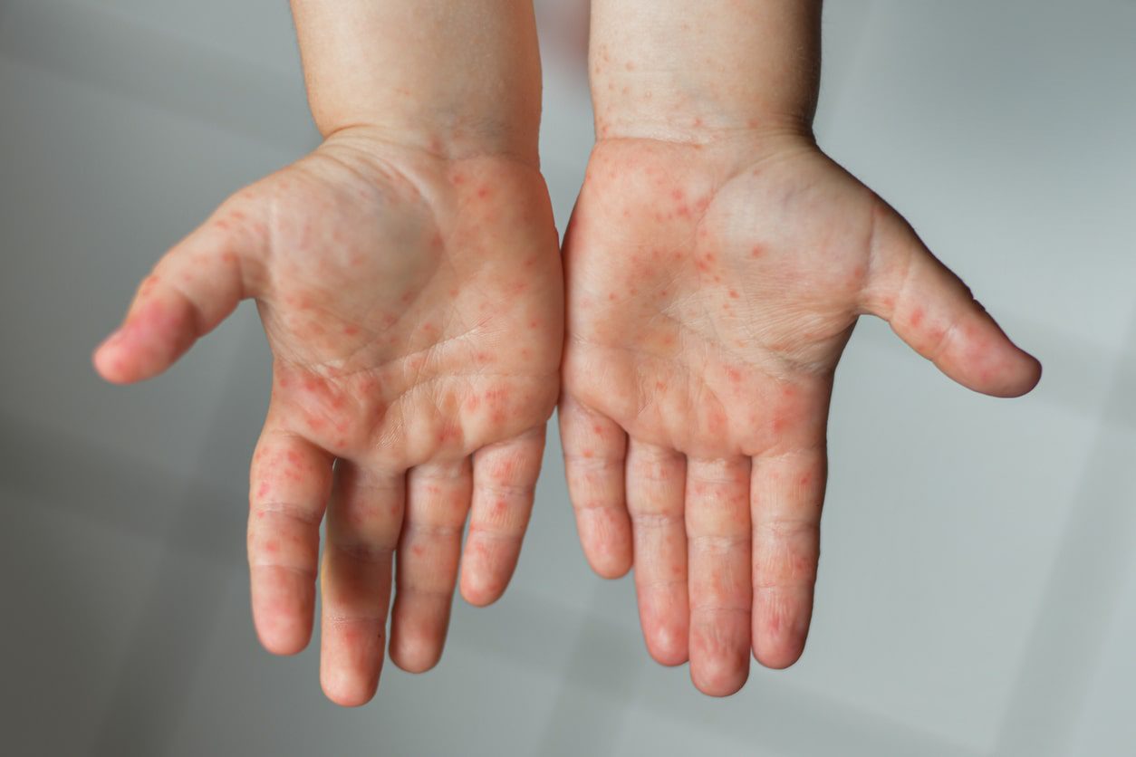 ¿Qué es el virus Coxsackie y cómo prevenirlo?