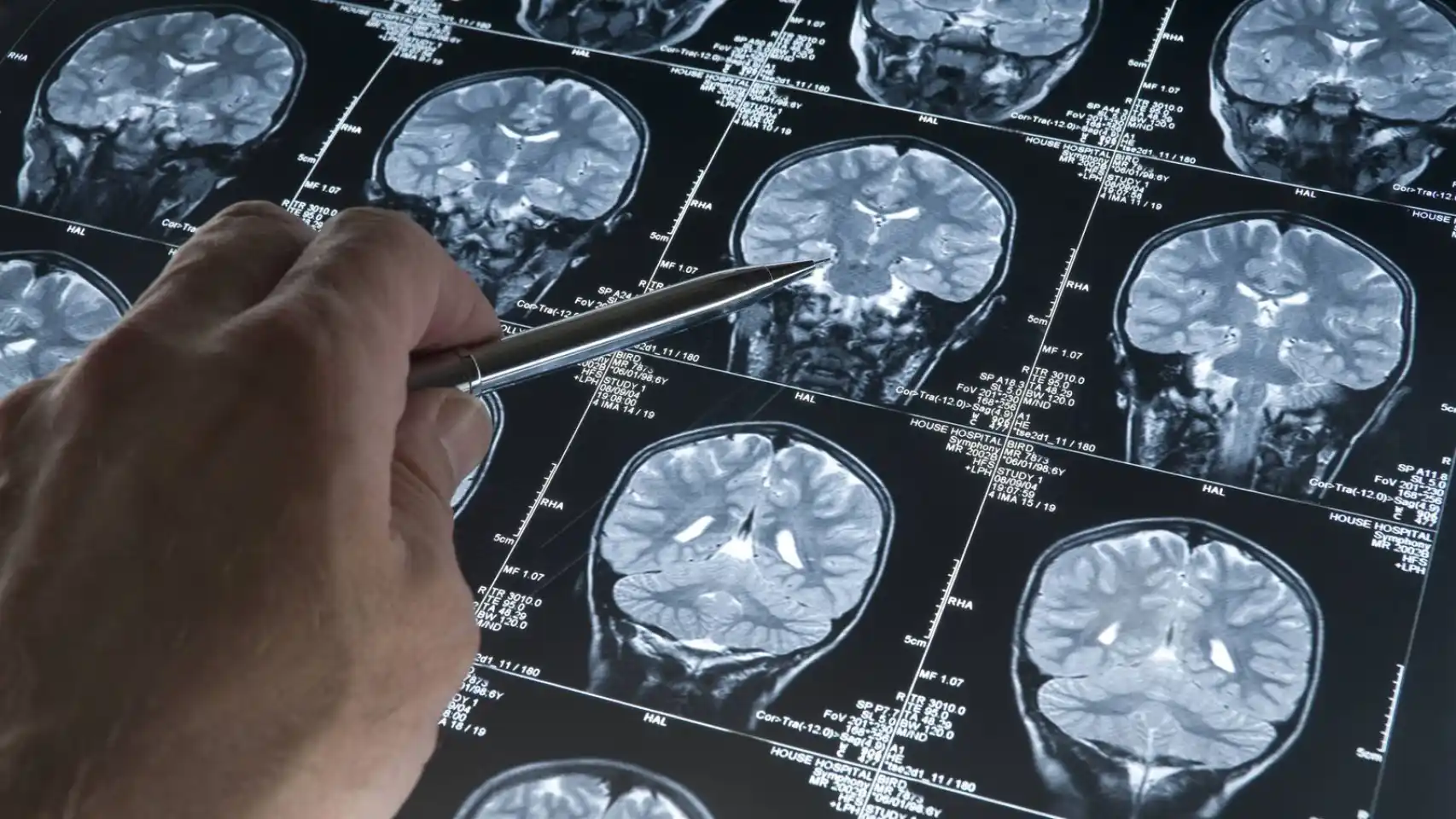 Joven de 19 años es diagnosticado con Alzheimer