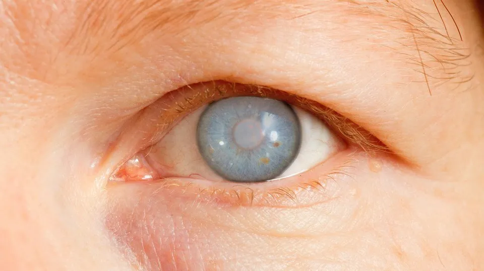 Pide Hospital de Cuernavaca hacerse revisión anual para detectar glaucoma